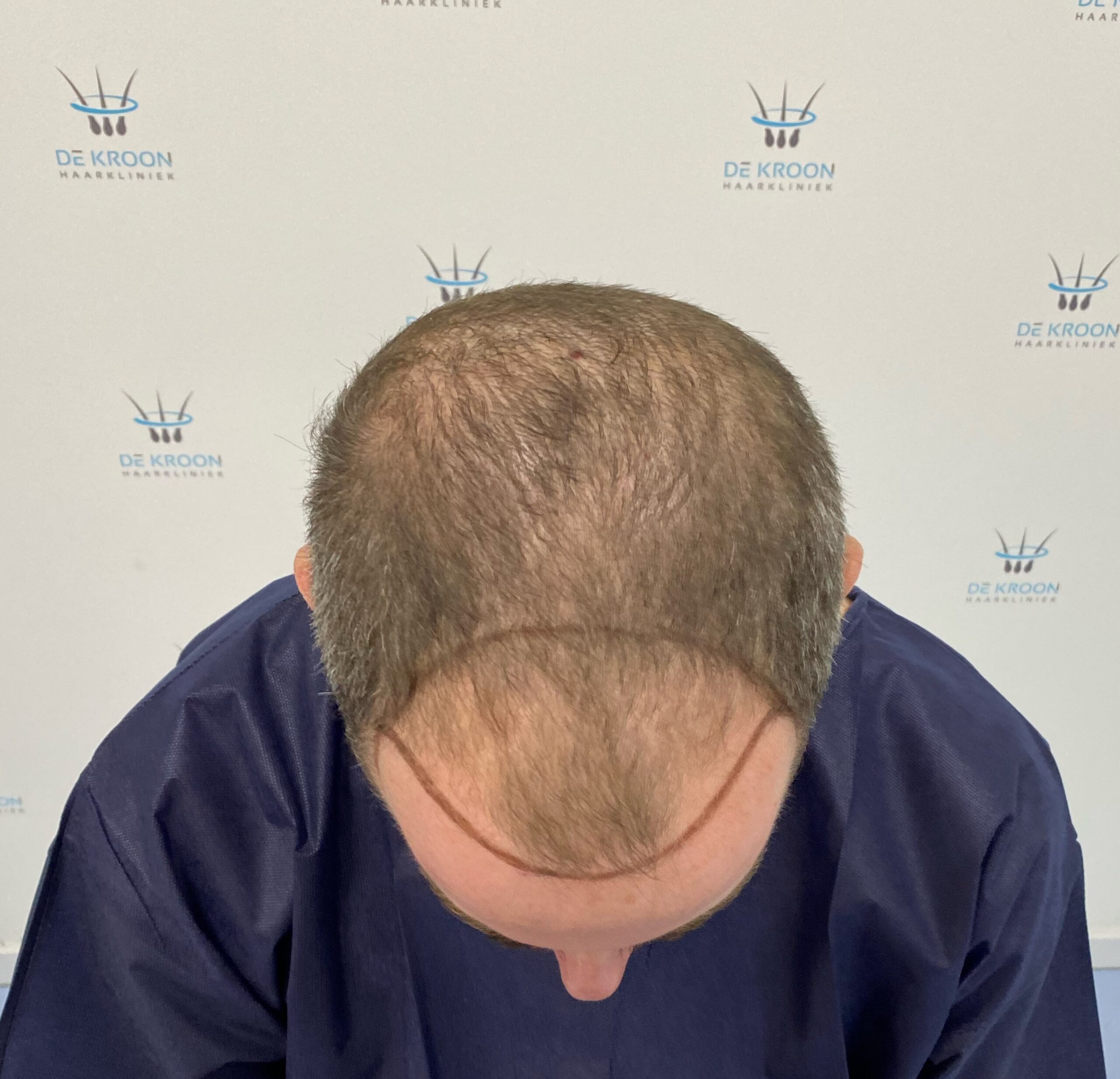 Haartransplantatie resultaat foto