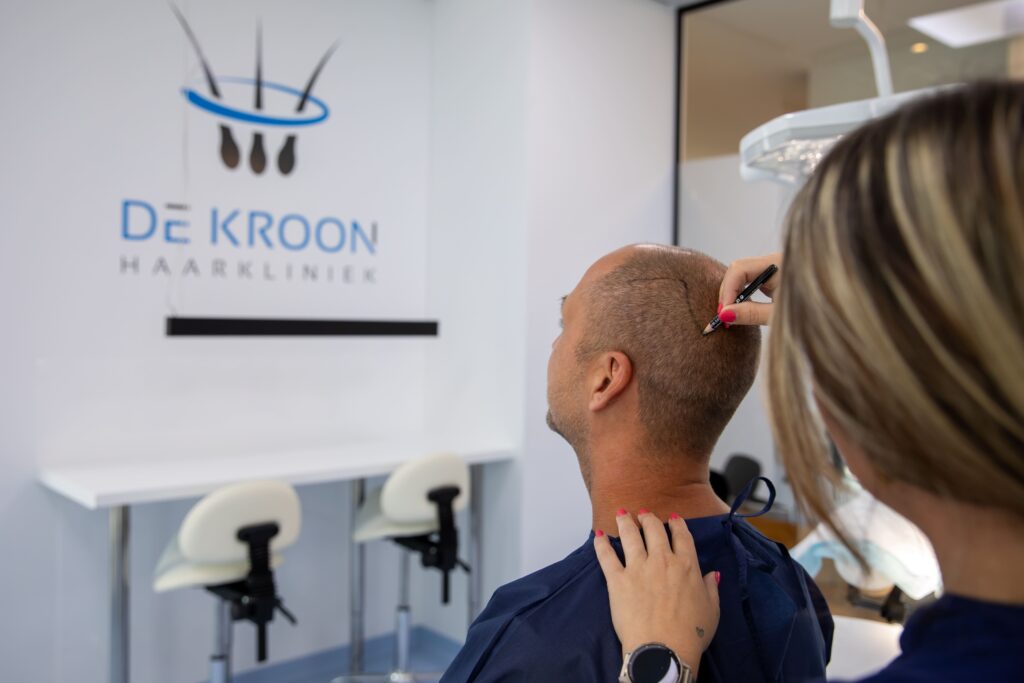Vrouw tekent met potlood op het hoofd van een man het donorgebied uit.