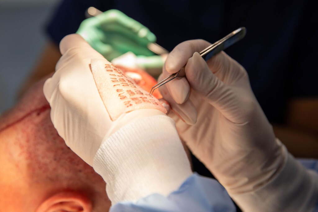 Nauwkeurige plaatsing van haarzakjes tijdens haartransplantatie door chirurg.